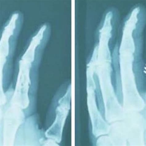 Rigid fixation of comminuted diaphyseal fracture. (A) Diaphyseal... | Download Scientific Diagram