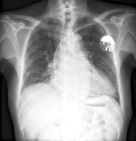 Pacemaker - ECGpedia