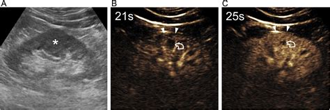 Contrast Enhanced Ultrasound For Characterizing Renal Masses European