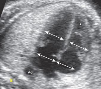 Ultrasound of Normal Fetal Heart | Radiology Key