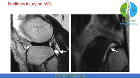 Popliteus Tendinitis | OrthoFixar 2025