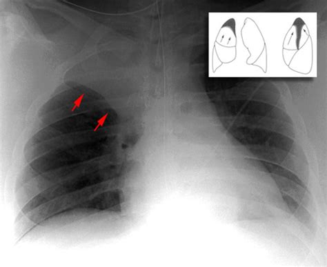 Chest Radiography Flashcards Quizlet