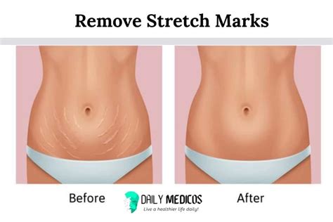 How To Remove Stretch Marks Causes And Effective Remedies To Get Rid