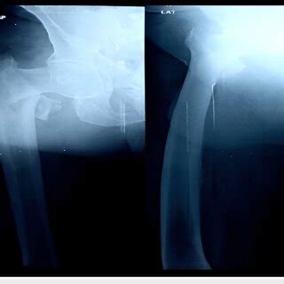 Anteroposterior X Ray View Of A 70 Year Old Male Showing An Unstable