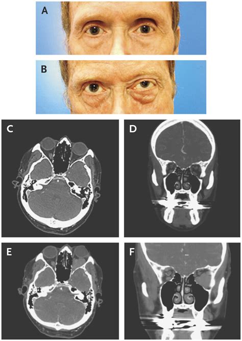 Orbital Varix New England Journal Of Medicine