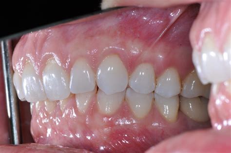 Gingival Gum Grafting Dental Implants Periodontics Of CT