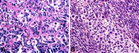 Mixed Germ Cell Sex Cord Stromal Tumour Of The Testis And Ovary