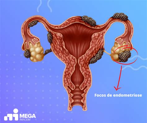 Endometriose Kanzispriyangi