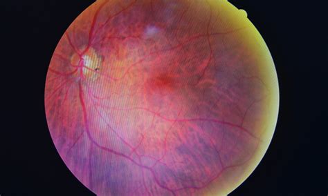 Retinopathy Symptoms