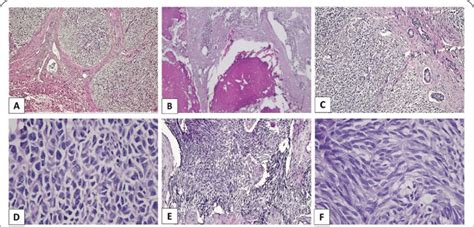 Photomicrographs Of Hande Stained Sections Revealed Well Circumscribed