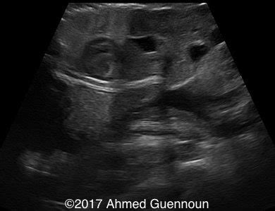 📃 Omphalocele