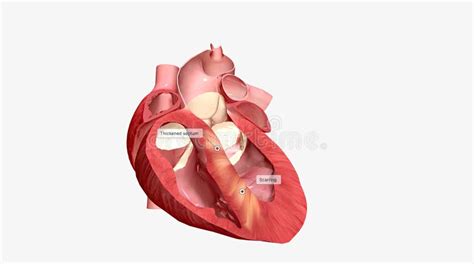 Several Heart Conditions Can Cause the Septum of the Heart To Thicken ...