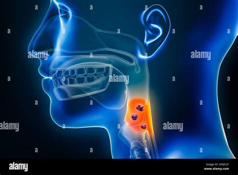 Laryngofaringe O Cancro Alla Gola Con Organi E Tumori O Cellule