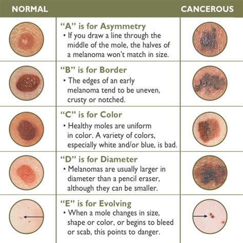 Skin Cancer Signs Of Skin Cancer Kimaja Farwani