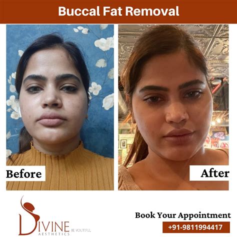 Face Fat Removal Surgery Shop | varsana.com