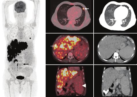 18F Labeled Fluoro 2 Deoxyglucose PET CT Maximum Intensity Projection