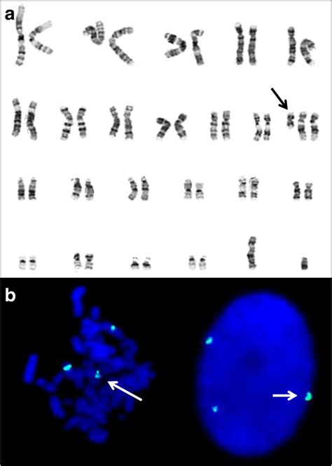 A G Banding Karyotype Of The Fibroblasts The Arrow Shows The Download Scientific Diagram