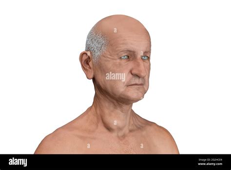 Thyroid Gland Tumour Illustration Stock Photo Alamy