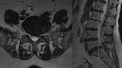 Case 2 MRI was performed revealing L5-S1 disc protrusion. | Download Scientific Diagram