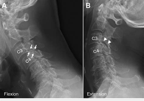 Preoperative Lateral Dynamic Radiographs Of The Cervical Spine Download Scientific Diagram