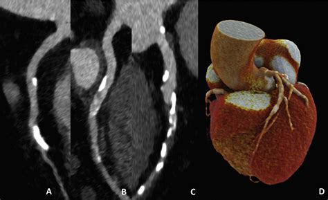 Dynamic Ct Myocardial Perfusion Imaging European Journal Of Radiology