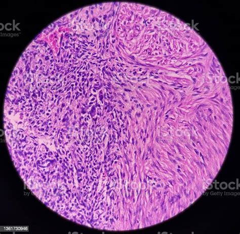 Uterus Wall Simple Endometrial Hyperplasia Show Revealing Features Of Simple Endometrial