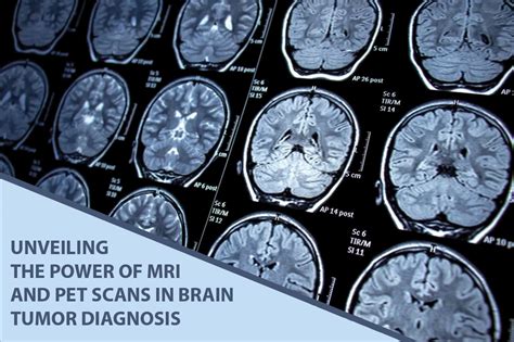 Brain Mri Scan Tumor