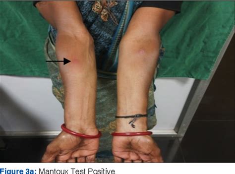 Figure From Tuberculosis Verrucosa Cutis Masqerading As