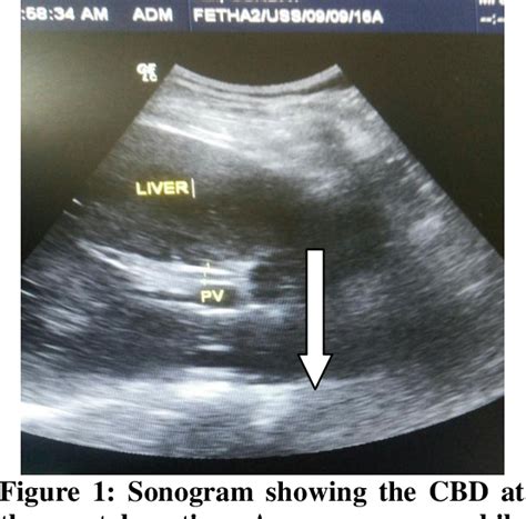 [pdf] Sonographic Measurement Of Common Bile Duct Diameter In