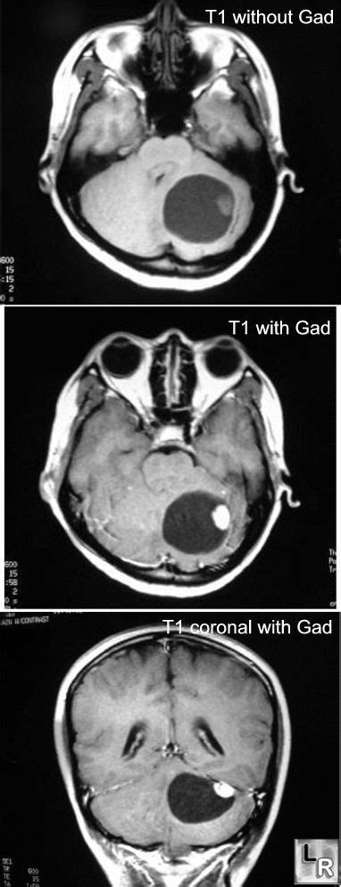 Mri Of Brain Shows A Cystic Lesion In The Cerebellum With An Enhancing