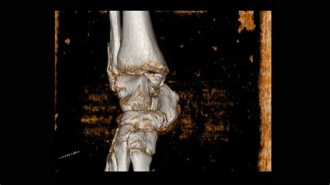 Ct Scan D Ankle Joint Views A Woman Stock Video Pond