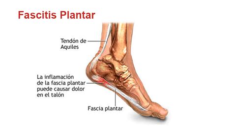 Fascitis Plantar Que Es Y Como Prevenirla