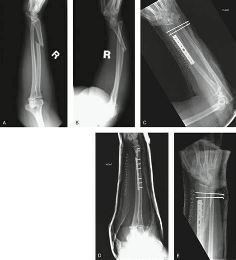 Galeazzi Fracture-Dislocations | Clinical Gate