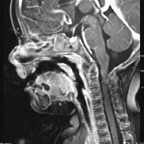 Pre Operative Photo Of Our Patients Lingual Dermoid Cyst Download