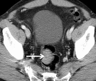 Axial Contrast Enhanced Ct Shows Histopathology Proven Rectal