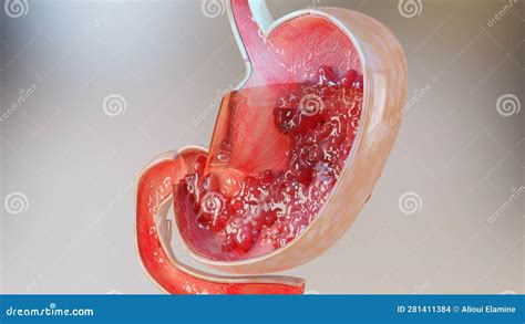 Stomach Cancer Stages Tumor Growth In Digestive System Peptic Ulcer Cancer Attacking Cell