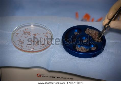 Hair Transplantation Process Pulling Hair Follicles Stock Photo