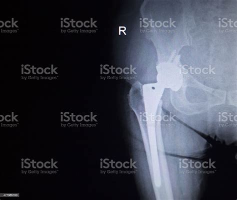 Xray Scan Image Of Hip Joint Replacement Orthopedic Implant Stock Photo