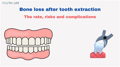 Tooth Extraction With Bone Loss At Steve Michelle Blog