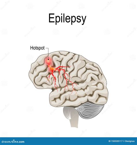 Epilepsy Brain Diagram