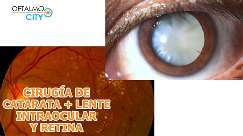 Procedimiento de cirugía de catara colocación de lente intraocular y