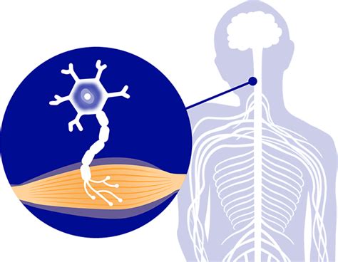 Amyotrophic Lateral Sclerosis (ALS) Treatment in Delhi