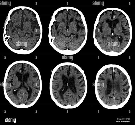 Alzheimers Disease Series Of Computed Tomography Ct Scans Of An