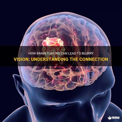 How Brain Tumors Can Lead To Blurry Vision Understanding The