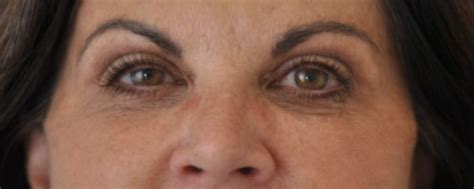 Brow Lift Case 6023 Faces PLLC In Ridgeland MS