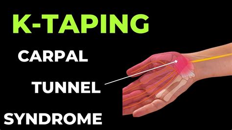 How To Treat Carpal Tunnel Syndrome Kinesiology Taping Youtube