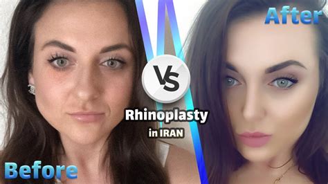 Rhinoplasty In Tehran Iran Gomediran Youtube