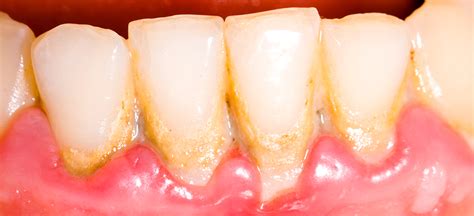 Periodontitis Causes Symptoms Diagnosis And Treatment Monash