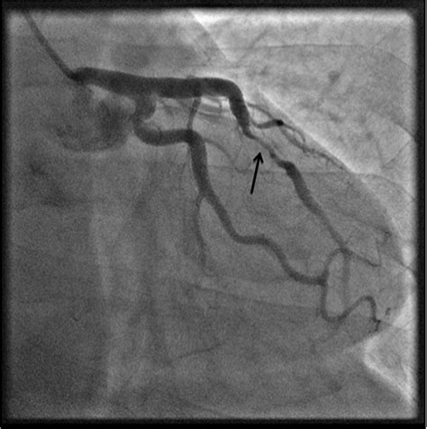 Figure 4 Cardiac Catheterization Revealed A Tubular 60 Stenosis Mid