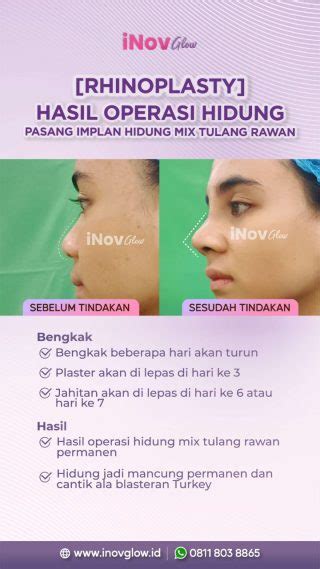 Rhinoplasty Prosedur Operasi Hidung Yang Dilakukan Di Klinik Inov Glow